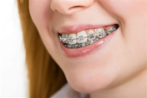 metal orthodontic bracket manufacturer|traditional metal braces for adults.